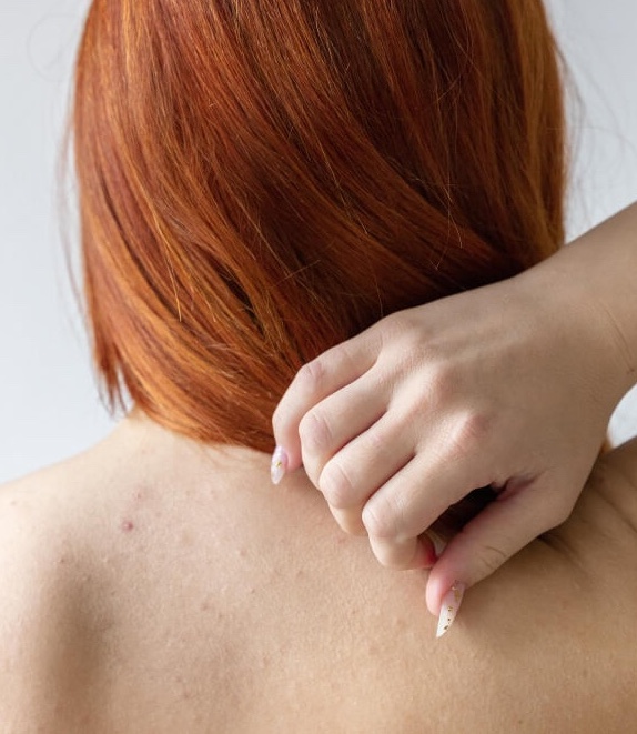 Problèmes de peau pour cette femme qui dévoile de l'acné dans son dos sous ses cheveux.